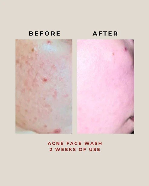 Nanoskin Acne Face Wash 100g - Image 4