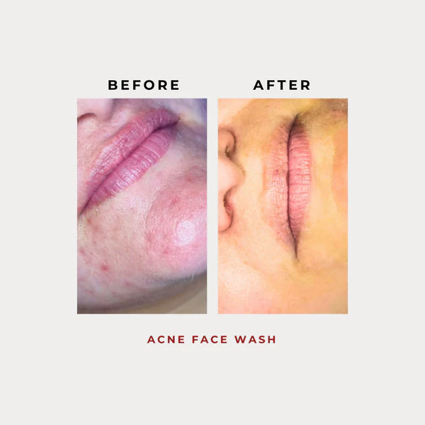 Nanoskin Acne Face Wash 100g - Image 5